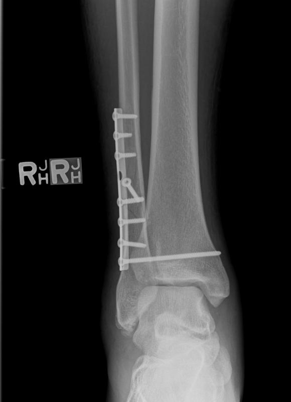 ankle_front_xray.jpg